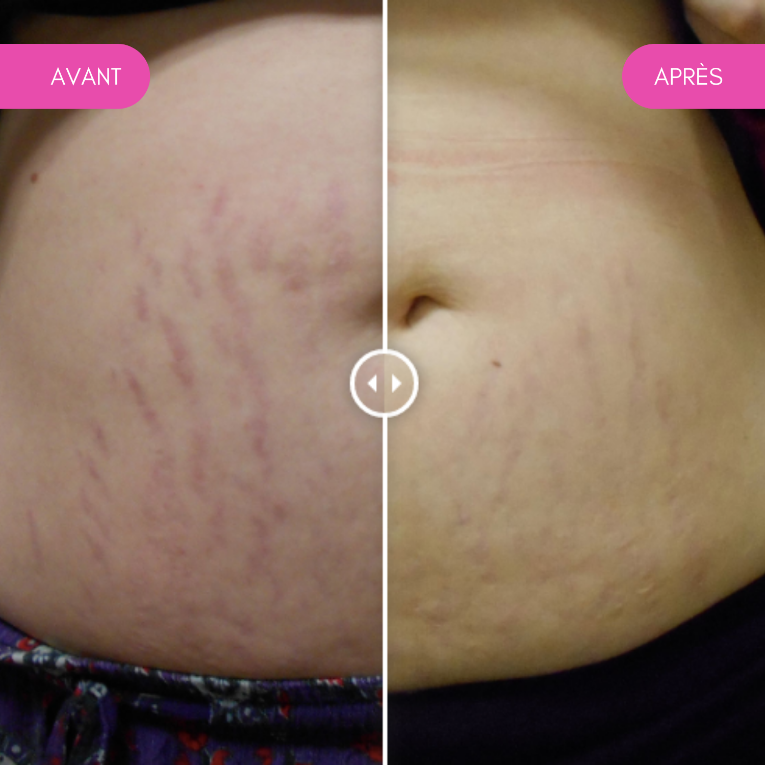 TRAITEMENT POUR LES VERGETURES Institut Maïa